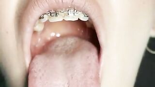 Gag reflex. Drooling and gagging by metal mouth