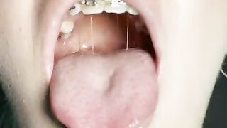 Gag reflex. Drooling and gagging by metal mouth