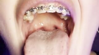 Gag reflex. Drooling and gagging by metal mouth