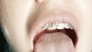 Gag reflex. Drooling and gagging by metal mouth