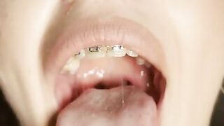 Gag reflex. Drooling and gagging by metal mouth