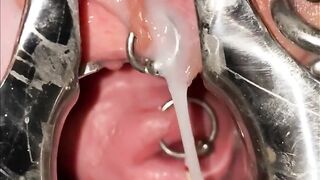 Extreme cervix sounding