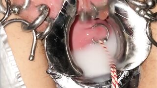 Extreme cervix sounding