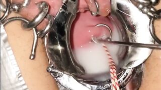 Extreme cervix sounding