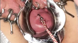 Extreme cervix sounding