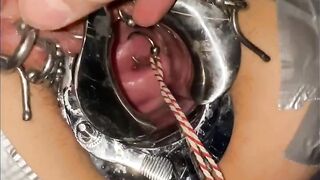 Extreme cervix sounding